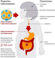 Полиомиелит.