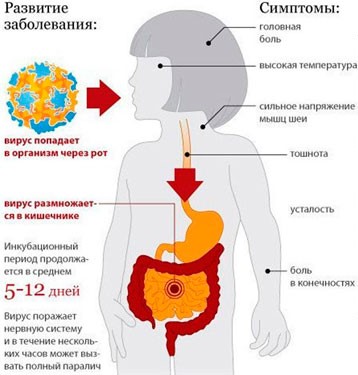 Полиомиелит Полиомиелит.
